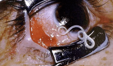 Parasites in the human body