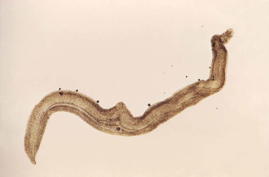 schistosomiasis